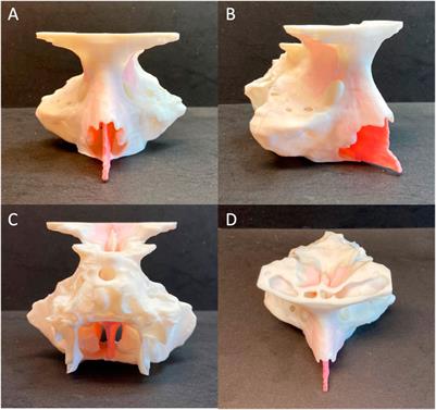 Assessment of a novel patient-specific 3D printed multi-material simulator for endoscopic sinus surgery